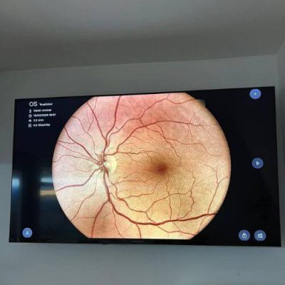 Retinografía Óptica Nazabal