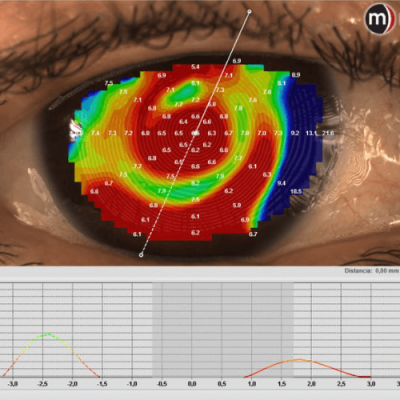 Topografía Óptica Nazabal